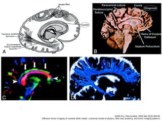 AJNR Am J Neuroradiol. 2004 Mar;25(3):356-69.
Diffusion tensor imaging of cerebral white matter: a pictorial review of physics, fiber tract anatomy, and tumor imaging patterns.
 