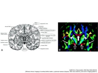 AJNR Am J Neuroradiol. 2004 Mar;25(3):356-69.
Diffusion tensor imaging of cerebral white matter: a pictorial review of physics, fiber tract anatomy, and tumor imaging patterns.
 