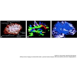 AJNR Am J Neuroradiol. 2004 Mar;25(3):356-69.
Diffusion tensor imaging of cerebral white matter: a pictorial review of physics, fiber tract anatomy, and tumor imaging patterns.
 