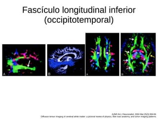 Fascículo longitudinal inferior
(occipitotemporal)
AJNR Am J Neuroradiol. 2004 Mar;25(3):356-69.
Diffusion tensor imaging of cerebral white matter: a pictorial review of physics, fiber tract anatomy, and tumor imaging patterns.
 