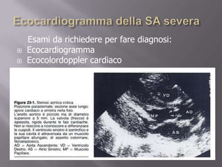 Ecocardiogramma della SA severa    Esami da richiedere per fare diagnosi:EcocardiogrammaEcocolordoppler cardiaco