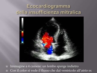 Ecocardiogramma della insufficienza mitralicaImmagine a 4 camere: un lembo sporge indietroCon il color si vede il flusso che dal ventricolo all’atrio sx