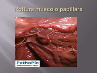 Rottura muscolo papillare