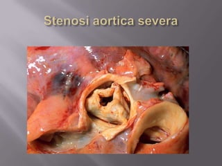 Stenosi aortica severa