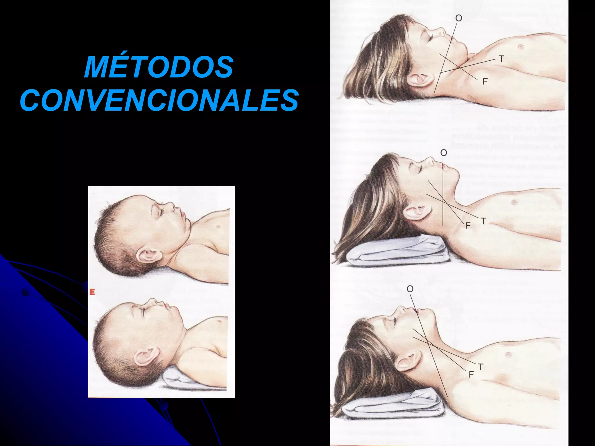 MÉTODOS
CONVENCIONALES
 