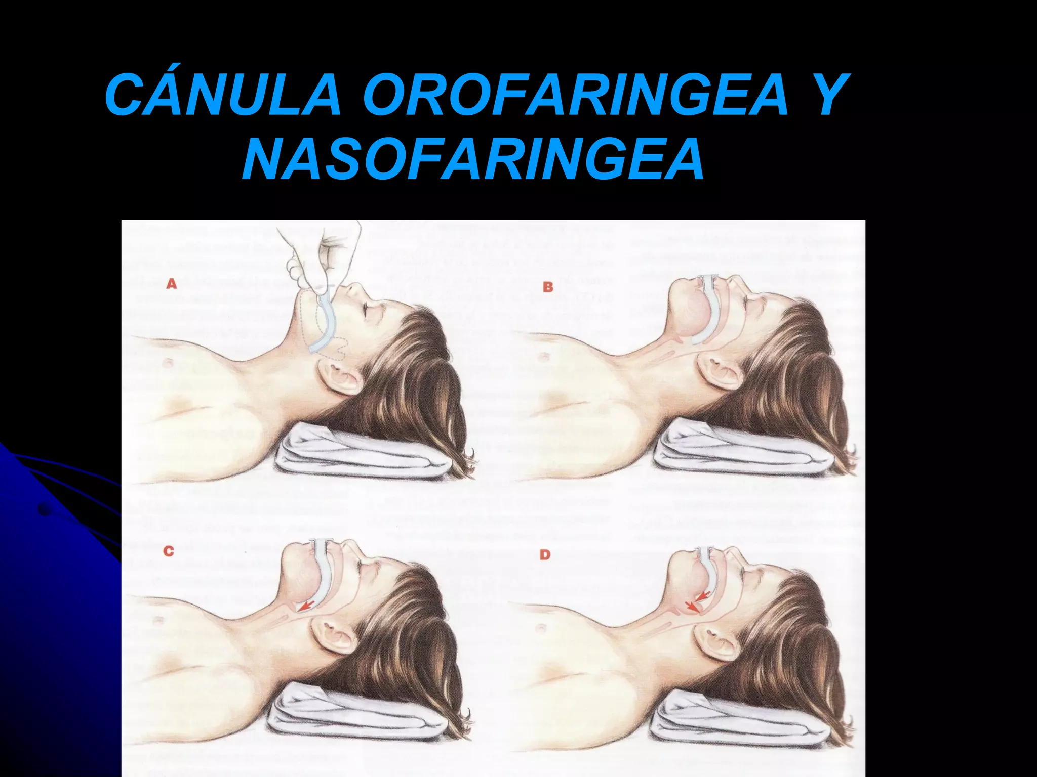 CÁNULA OROFARINGEA Y
   NASOFARINGEA
 