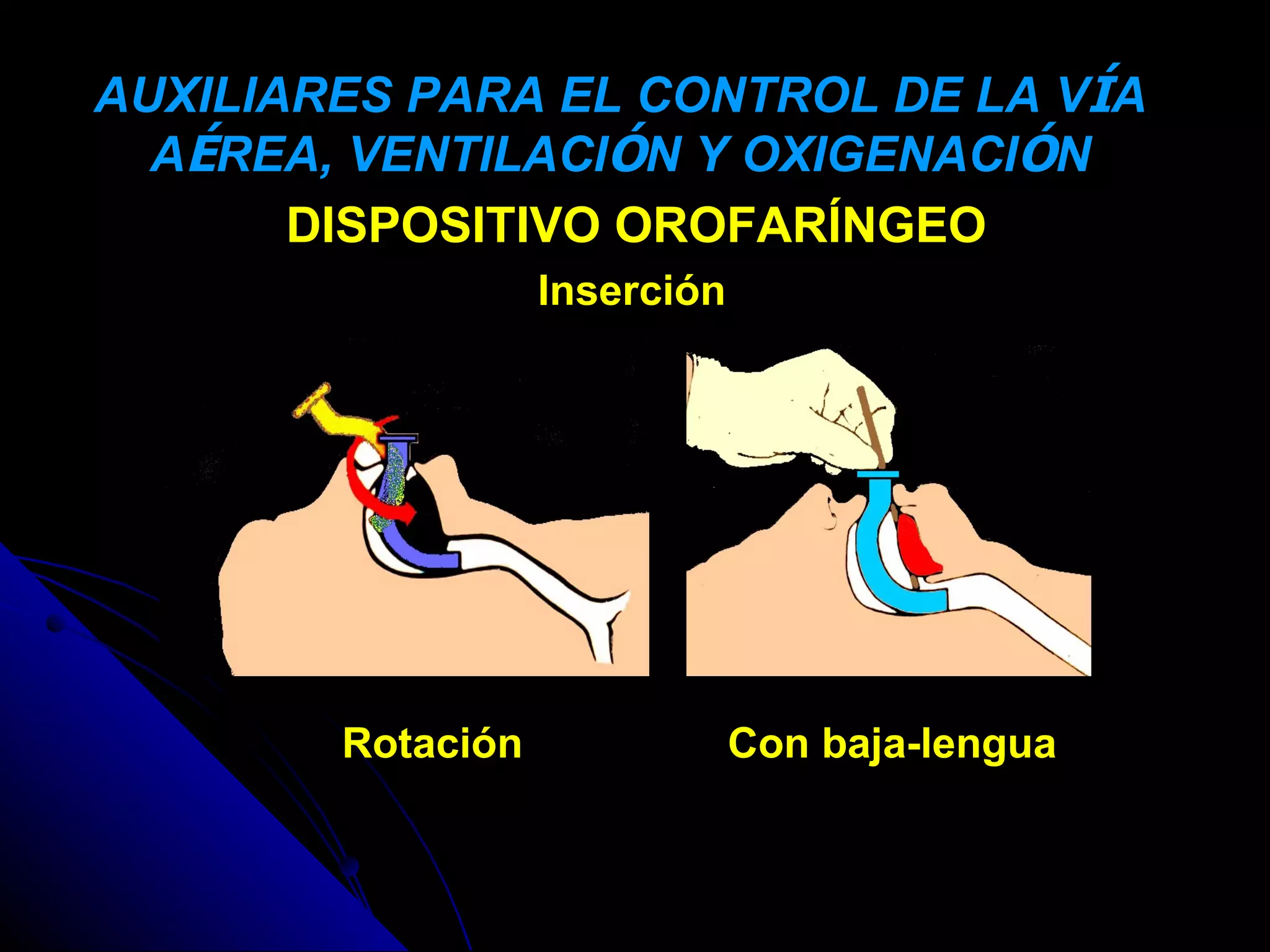 AUXILIARES PARA EL CONTROL DE LA VÍA
  AÉREA, VENTILACIÓN Y OXIGENACIÓN
       DISPOSITIVO OROFARÍNGEO
                   Inserción




        Rotación               Con baja-lengua
 