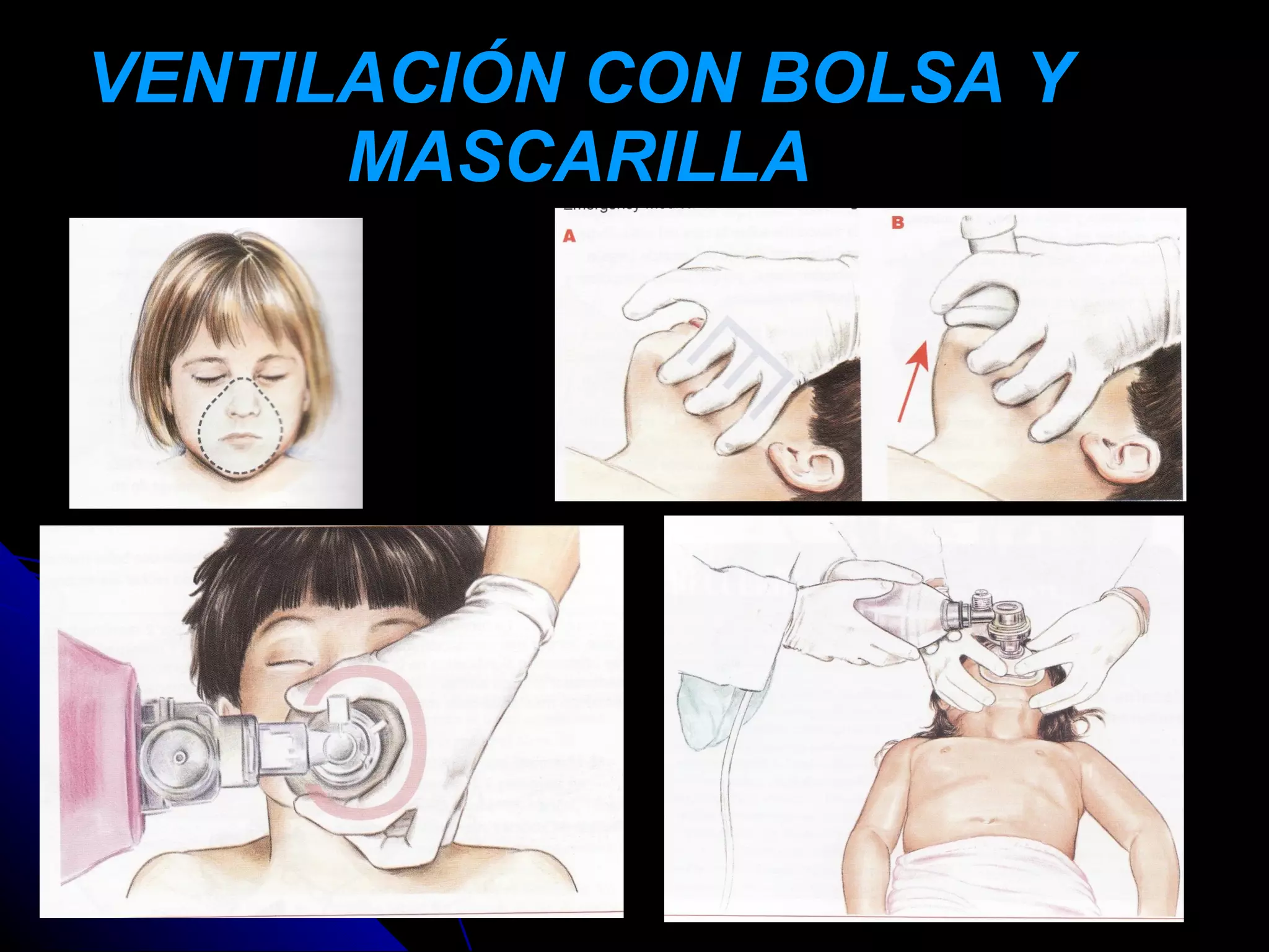 VENTILACIÓN CON BOLSA Y
      MASCARILLA
 