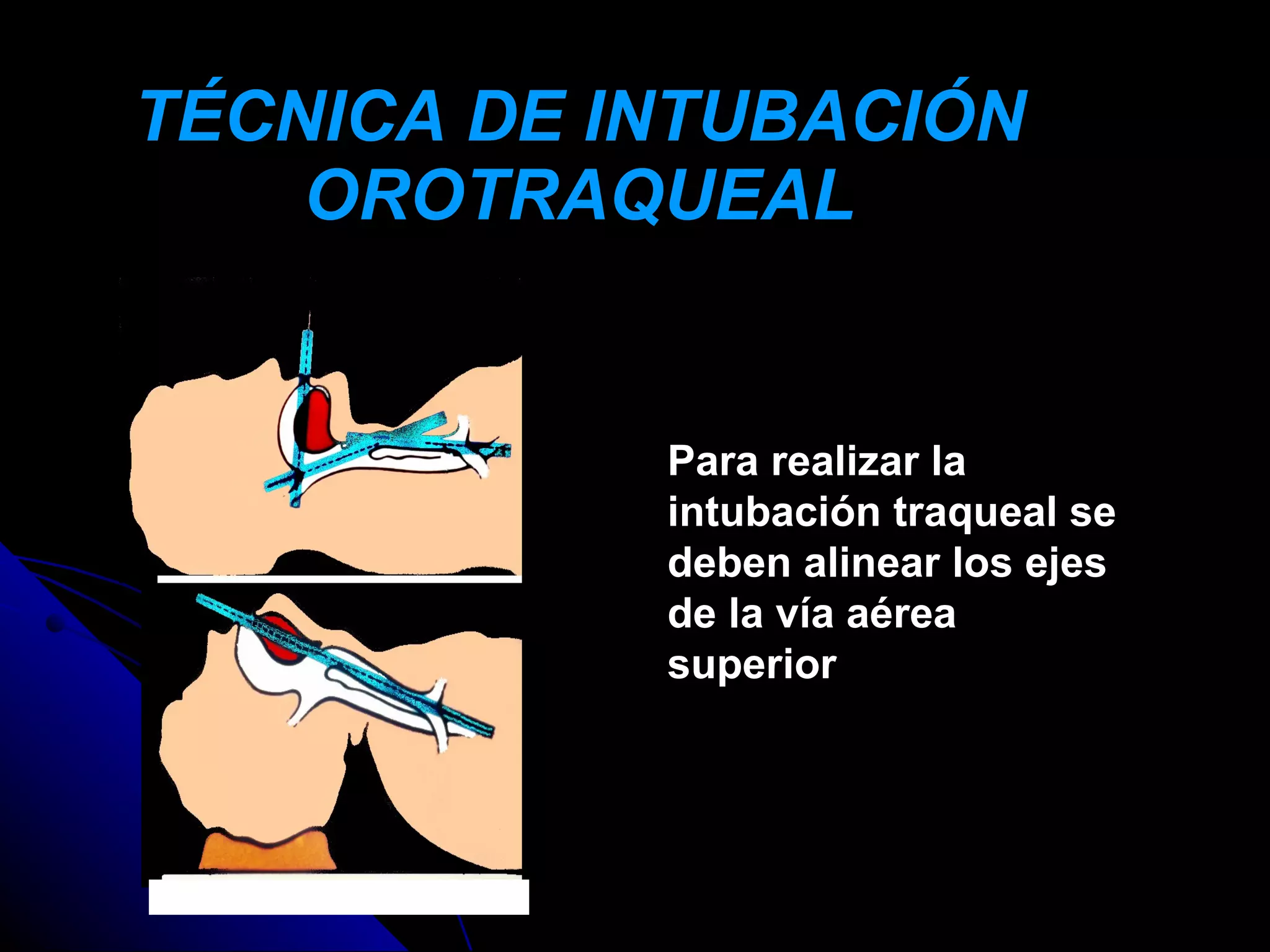 TÉCNICA DE INTUBACIÓN
    OROTRAQUEAL


            Para realizar la
            intubación traqueal se
            deben alinear los ejes
            de la vía aérea
            superior
 