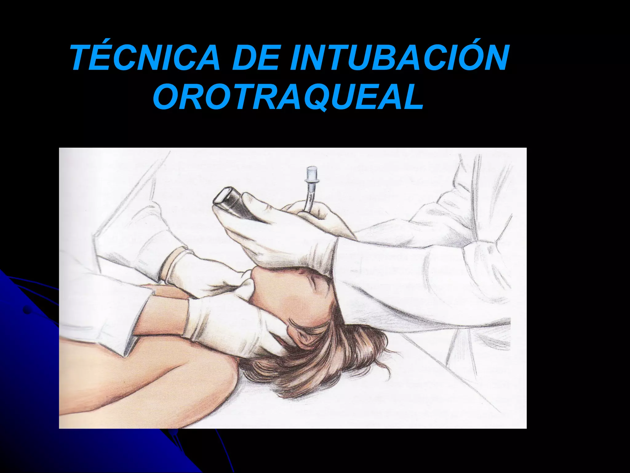 TÉCNICA DE INTUBACIÓN
    OROTRAQUEAL
 
