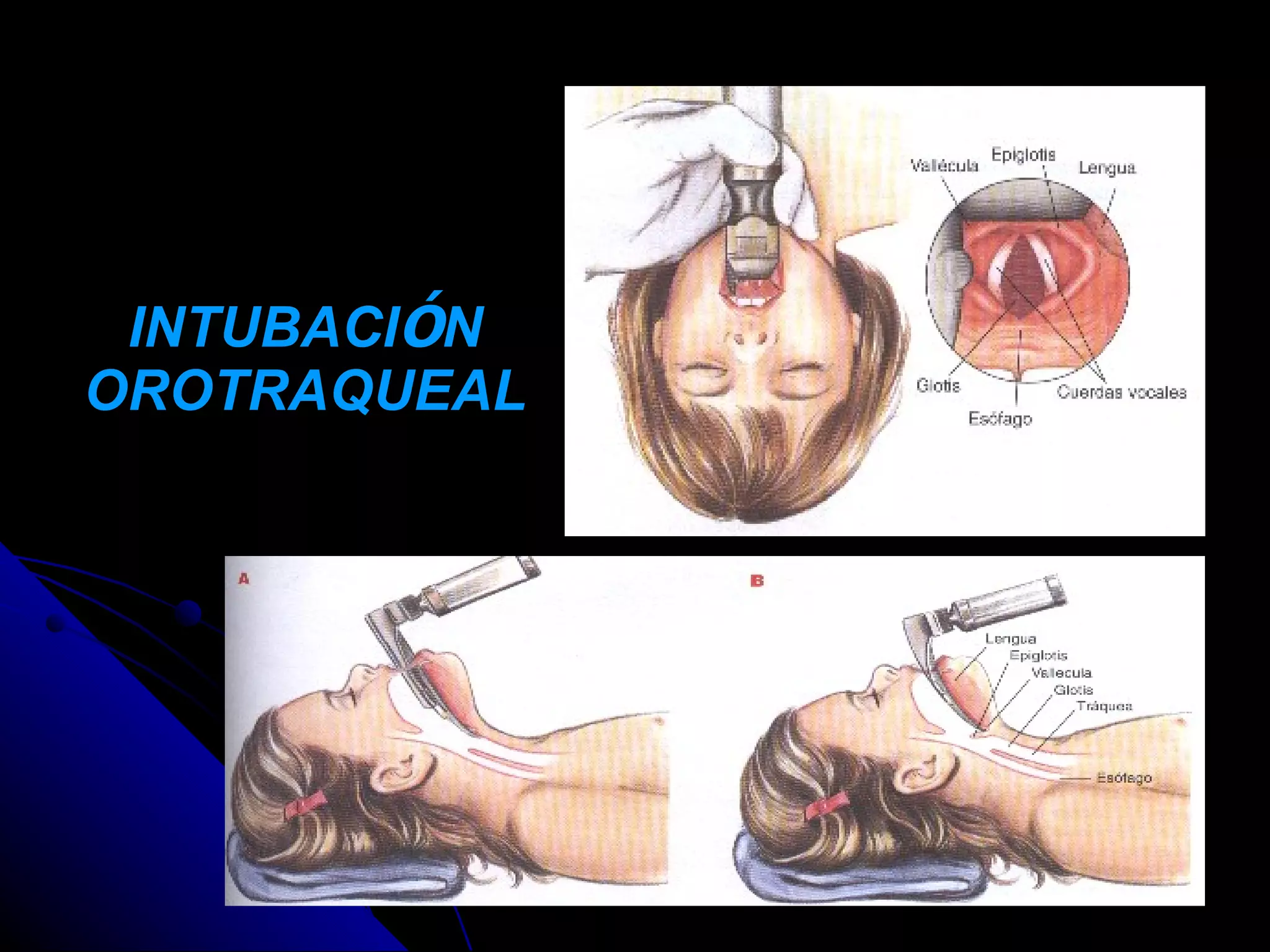 INTUBACIÓN
OROTRAQUEAL
 