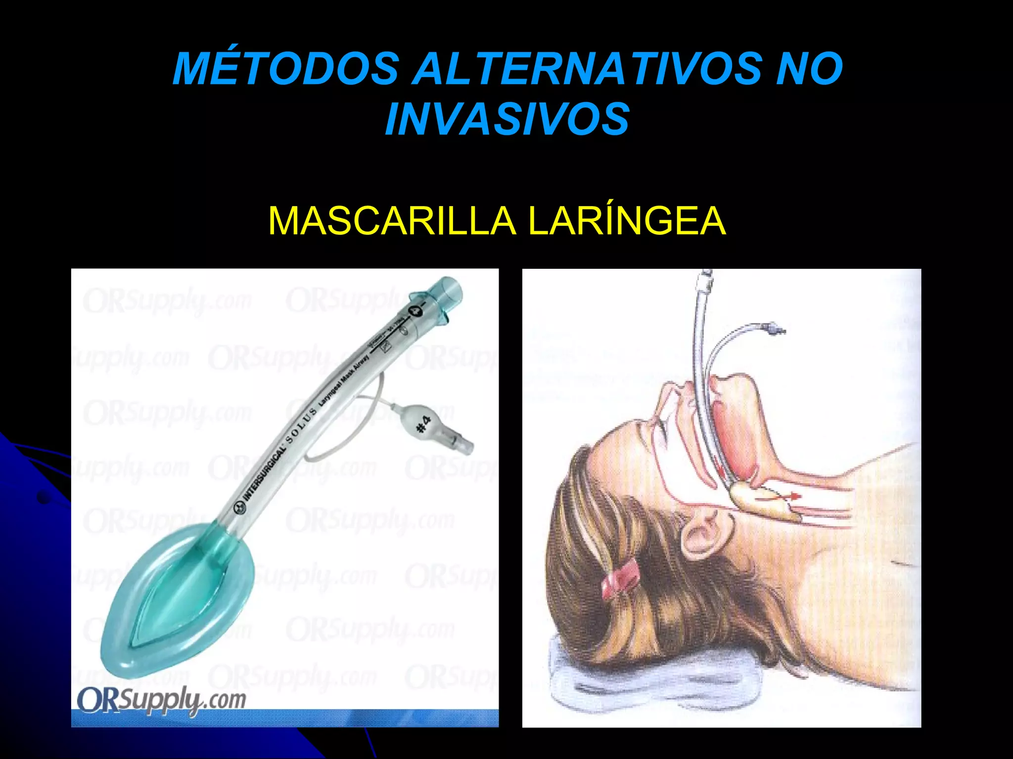 MÉTODOS ALTERNATIVOS NO
       INVASIVOS

   MASCARILLA LARÍNGEA
 