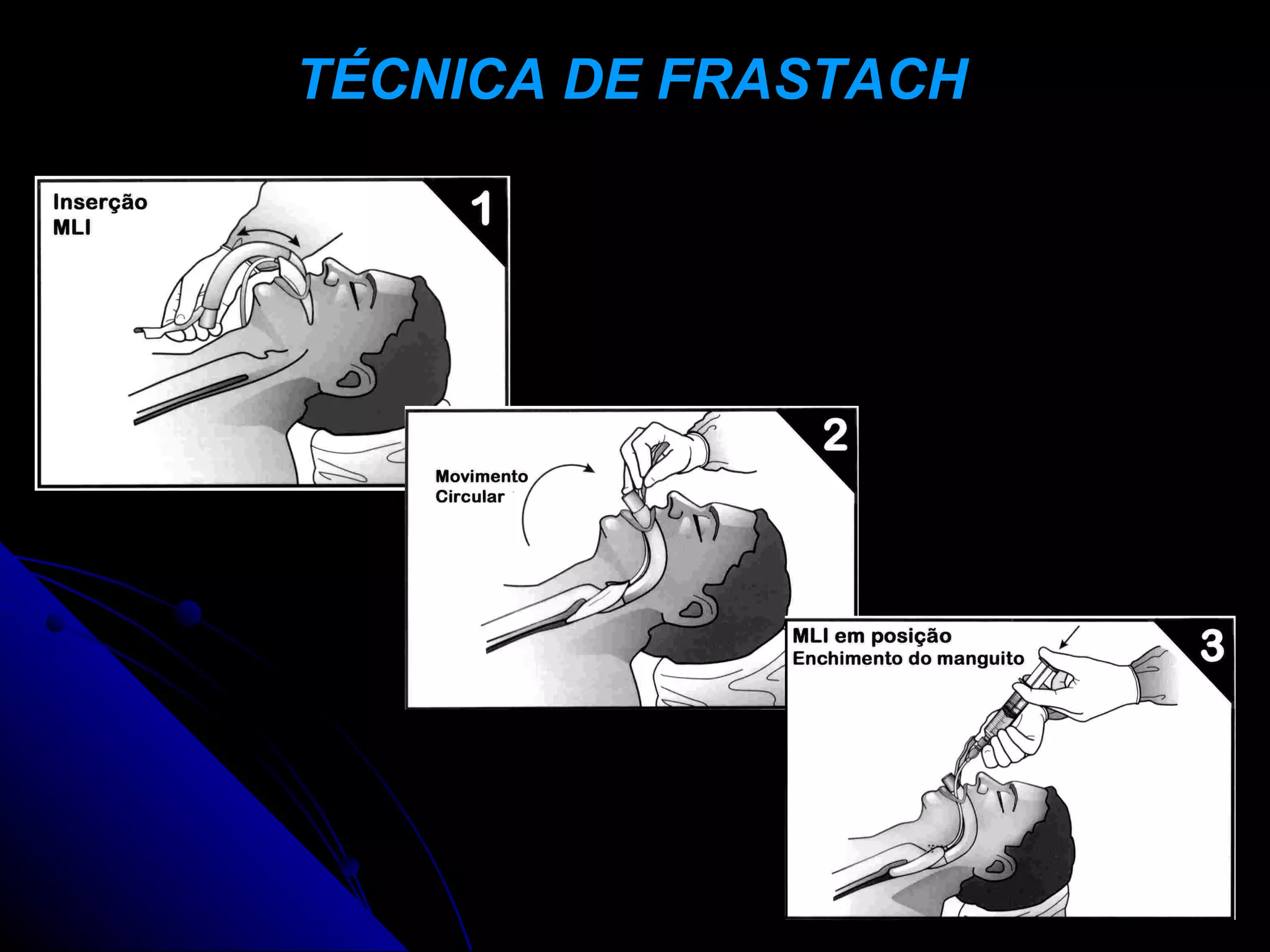 TÉCNICA DE FRASTACH
 