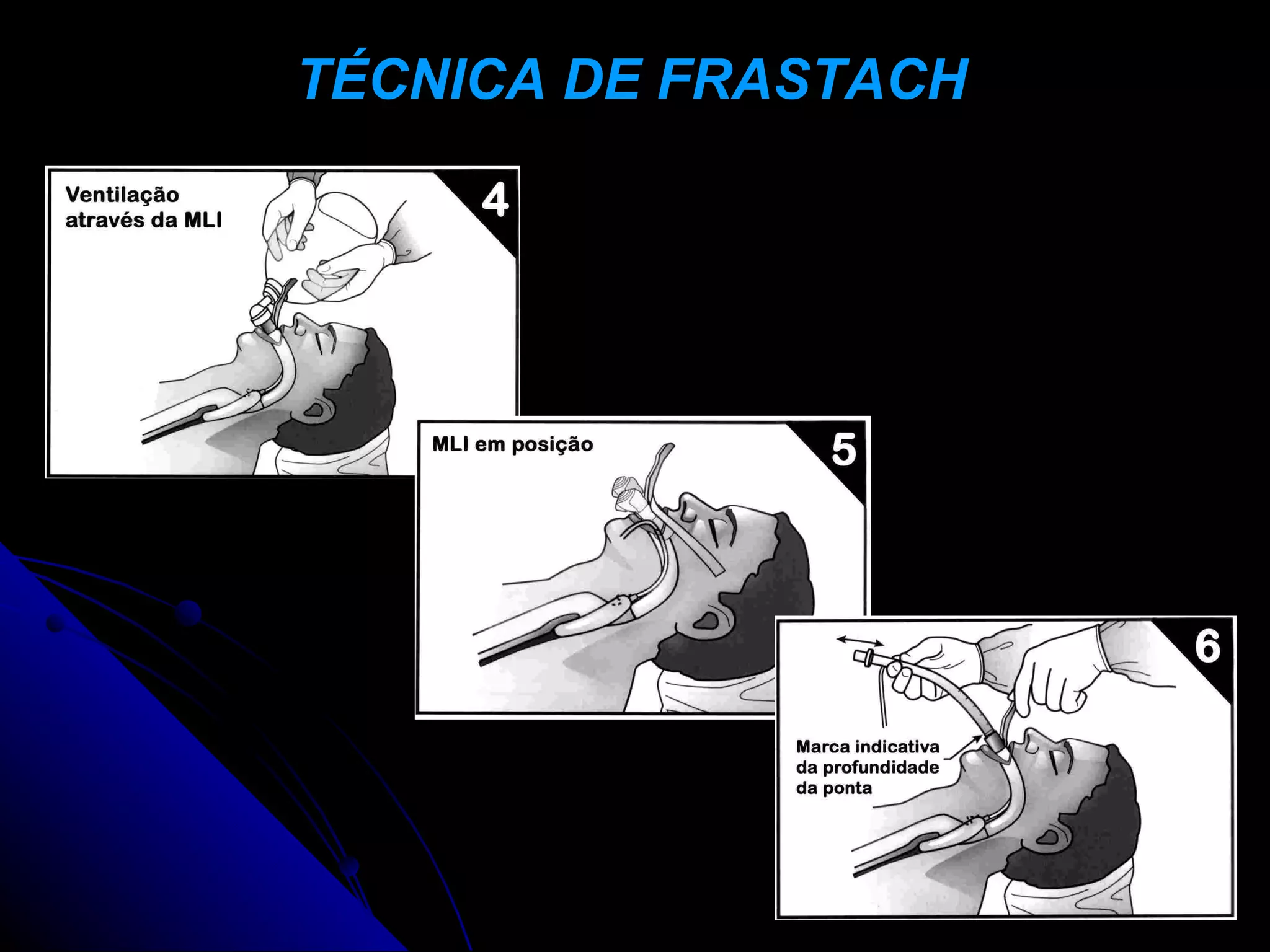 TÉCNICA DE FRASTACH
 