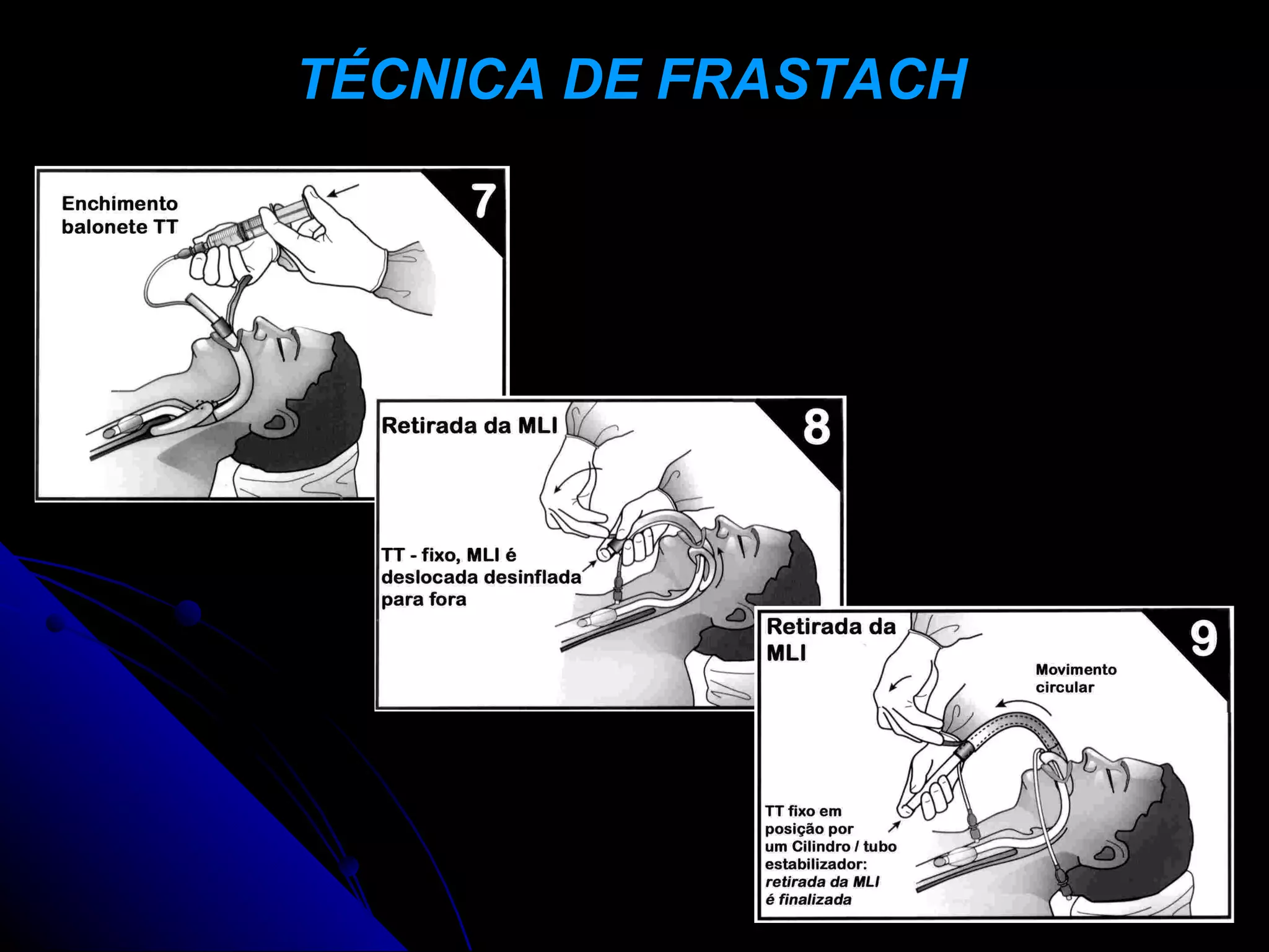 TÉCNICA DE FRASTACH
 