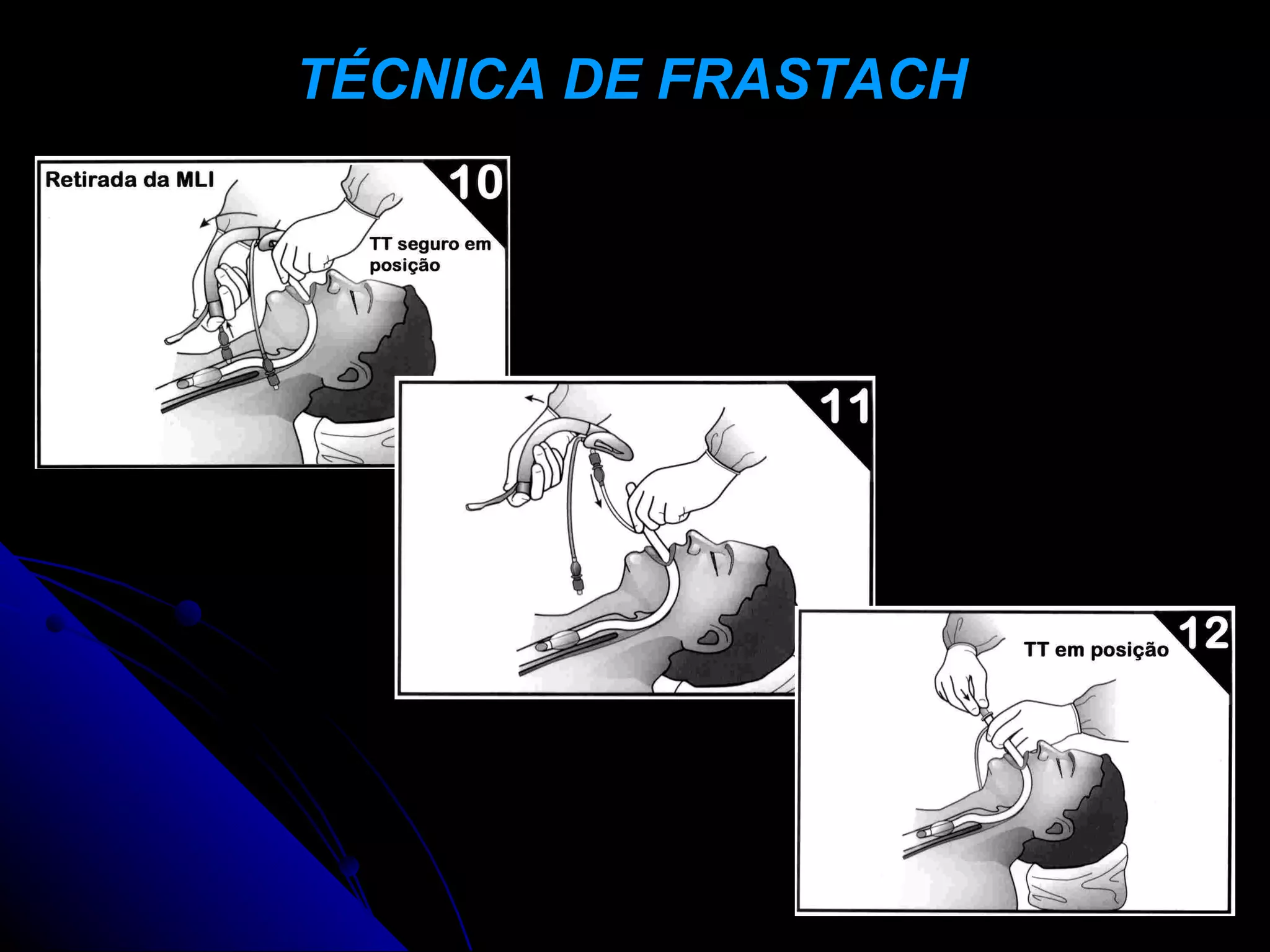 TÉCNICA DE FRASTACH
 