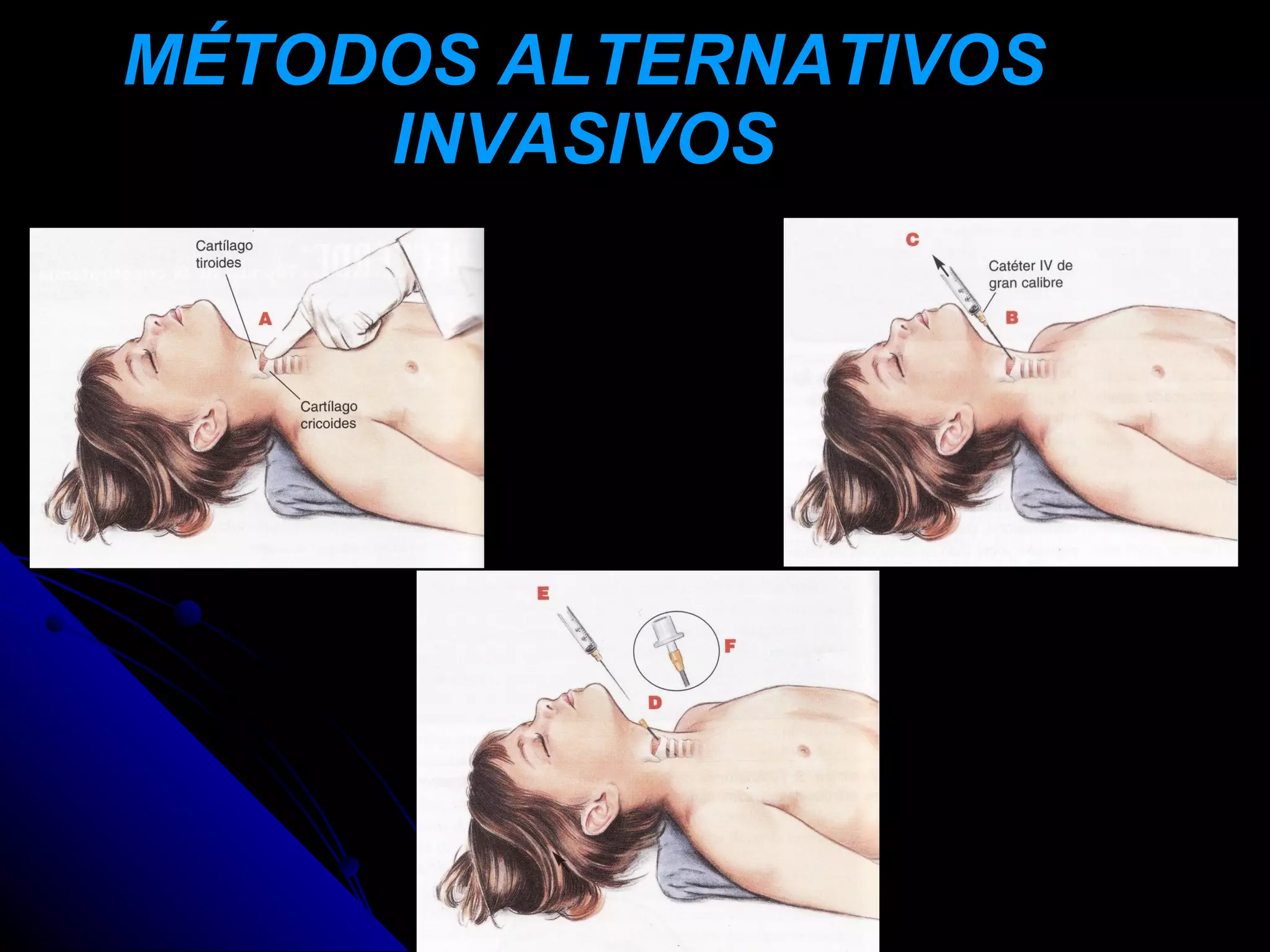 MÉTODOS ALTERNATIVOS
     INVASIVOS
 