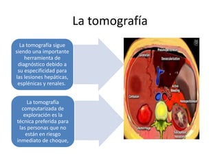 La tomografía
La tomografía sigue
siendo una importante
herramienta de
diagnóstico debido a
su especificidad para
las lesiones hepáticas,
esplénicas y renales.
La tomografía
computarizada de
exploración es la
técnica preferida para
las personas que no
están en riesgo
inmediato de choque,
 