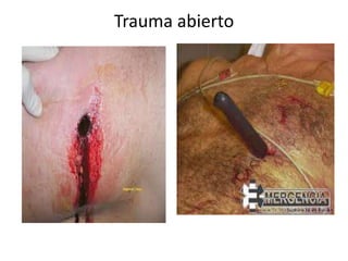 Trauma abierto
 