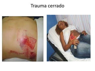 Trauma cerrado
 