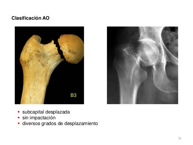 FRACTURAS DEL EXTREMO PROXIMAL DEL FEMUR