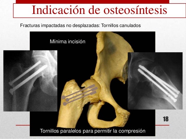 FRACTURAS DEL EXTREMO PROXIMAL DEL FEMUR