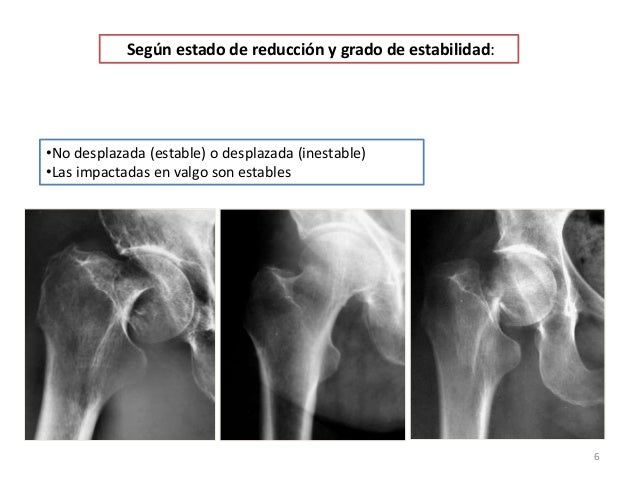 FRACTURAS DEL EXTREMO PROXIMAL DEL FEMUR FRACTURAS DEL EXTREMO PROXIMAL DEL FEMUR