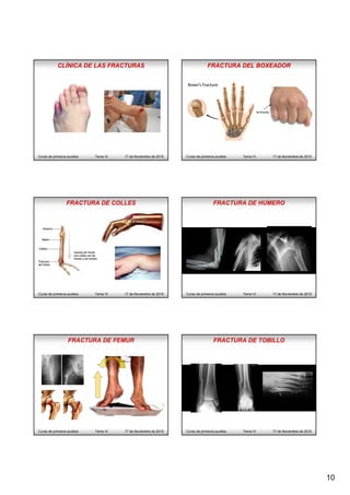 10
CLÍNICA DE LAS FRACTURAS
Curso de primeros auxilios Tema VI 17 de Noviembre de 2015
FRACTURA DEL BOXEADOR
Curso de primeros auxilios Tema VI 17 de Noviembre de 2015
FRACTURA DE COLLES
Curso de primeros auxilios Tema VI 17 de Noviembre de 2015
FRACTURA DE HUMERO
Curso de primeros auxilios Tema VI 17 de Noviembre de 2015
FRACTURA DE FEMUR
Curso de primeros auxilios Tema VI 17 de Noviembre de 2015
FRACTURA DE TOBILLO
Curso de primeros auxilios Tema VI 17 de Noviembre de 2015
 