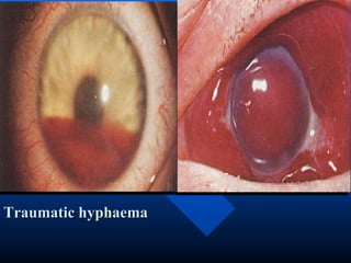 Traumatic hyphaema
 