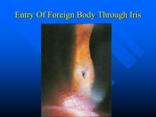 Entry Of Foreign Body Through Iris
 
