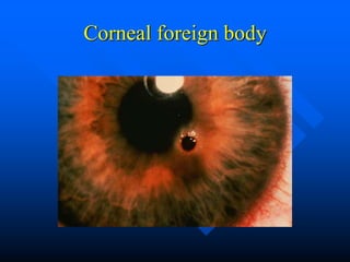 Corneal foreign body
 