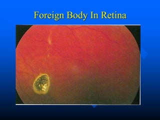 Foreign Body In Retina
 