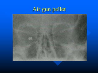 Air gun pellet
 