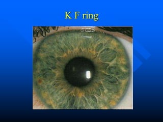 K F ring
 