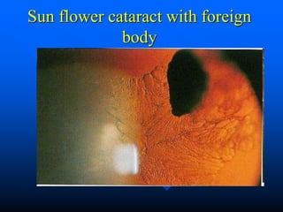 Sun flower cataract with foreign
body
 