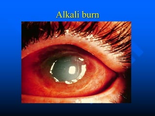 Alkali burn
 