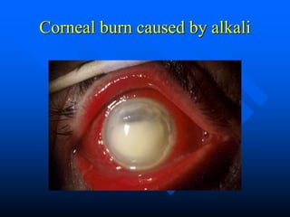 Corneal burn caused by alkali
 
