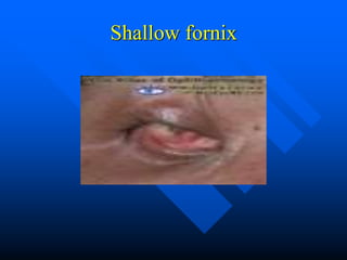 Shallow fornix
 