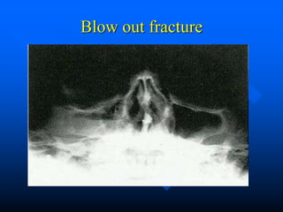Blow out fracture
 