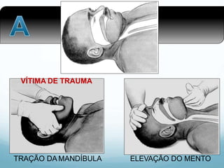 TRAÇÃO DA MANDÍBULA ELEVAÇÃO DO MENTO
VÍTIMA DE TRAUMA
 