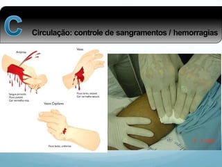 Circulação: controle de sangramentos / hemorragias
 