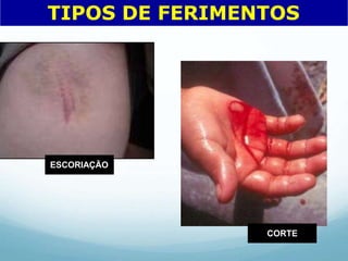 ESCORIAÇÃO
CORTE
TIPOS DE FERIMENTOS
 
