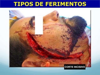 TIPOS DE FERIMENTOS
CORTE INCISIVO
 