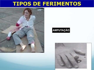 TIPOS DE FERIMENTOS
AMPUTAÇÃO
 