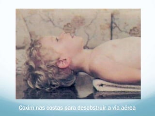 Coxim nas costas para desobstruir a via aérea
 