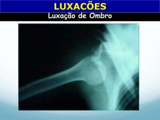 Luxação de Ombro
LUXACÕES
 