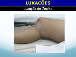 Luxação de Joelho
LUXACÕES
 