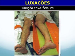 LUXACÕES
Luxação coxo-femural
 