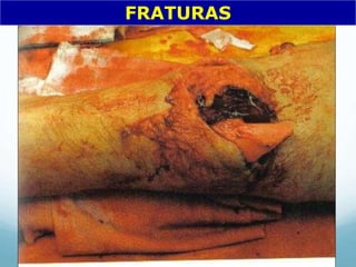 FRATURAS
 