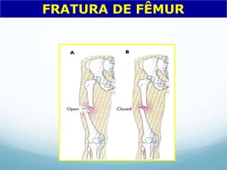 FRATURA DE FÊMUR
 